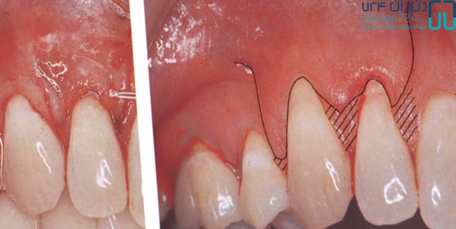تجهیزات دندانپزشکی فلپ ترمیم دندانی دندان724 dandan724