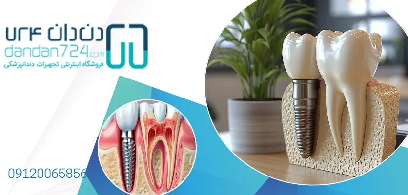 کاشت دندان - ایمپلنتولوژیست