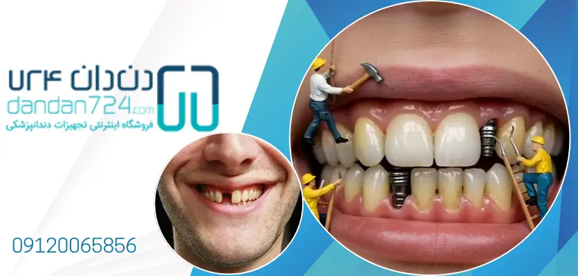 وظایف متخصص کاشت دندان-ایمپلنتولوژیست- 