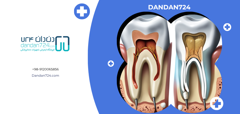 تفاوت ظاهری - اندو بلیچینگ دندانی