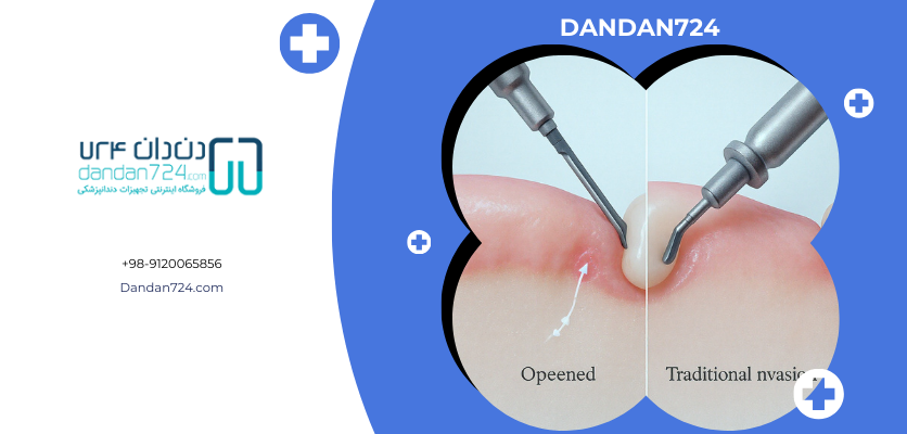 مراحل پانچ - ایمپلنت پانچ