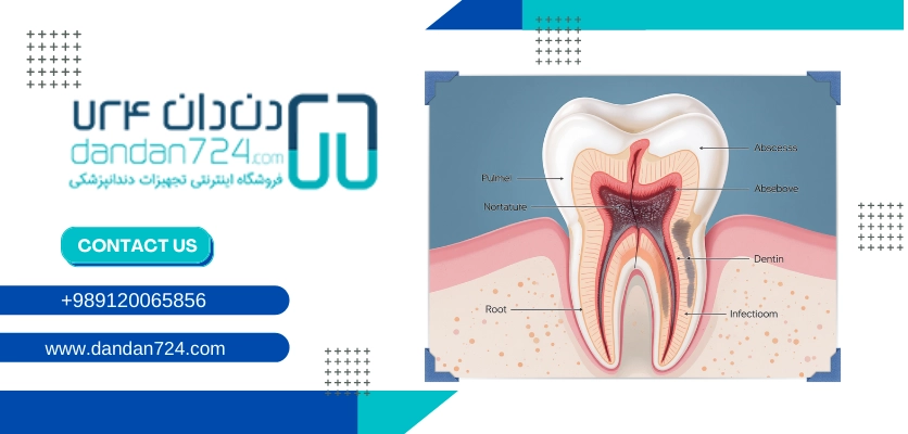 عدم درمان - نکروز دندان