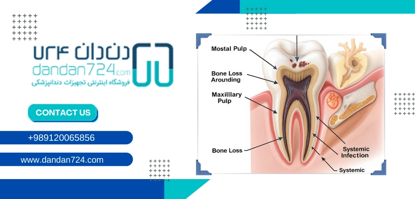 گسترش عفونت - نکروز دندان