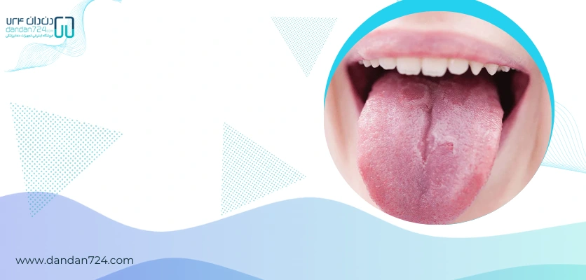 بیماری - برفک دهان