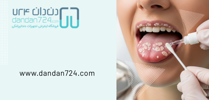 درمان-برفک دهان