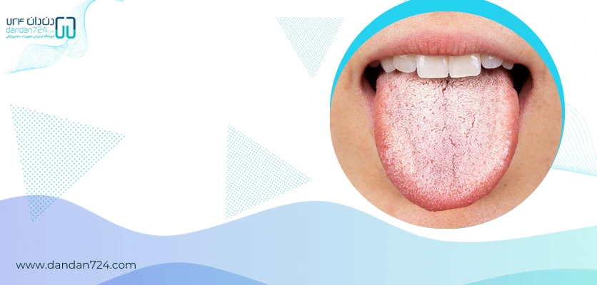 بیماری - برفک دهان