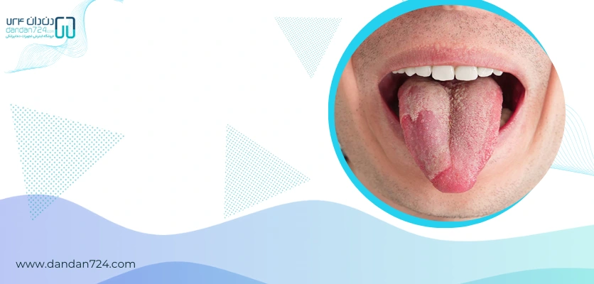 نشانه ها - برفک دهان