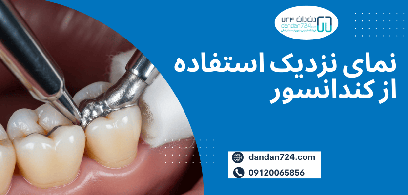 نمای نزدیک کندانسور - کاربرد کندانسور دندانپزشکی