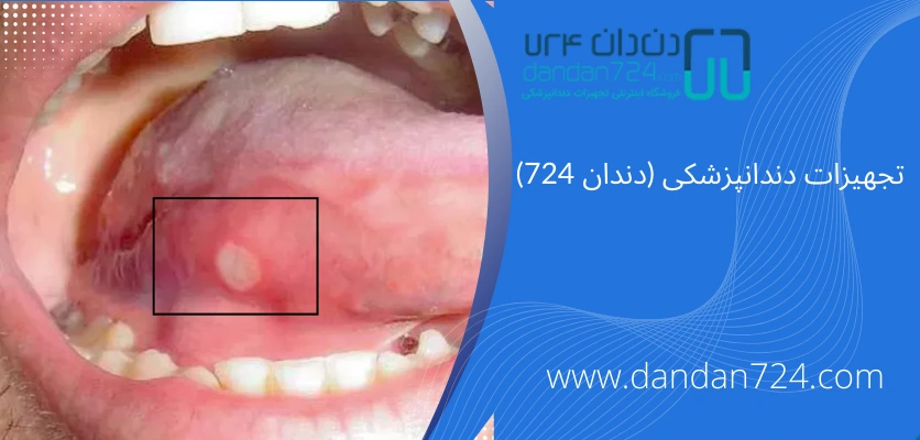 بیماری های دهانی - عفونت دندان