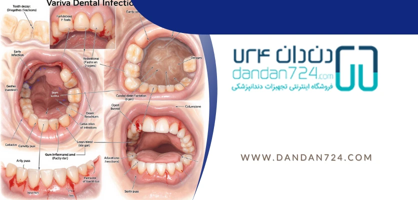 انواع عفونت ها - عفونت دندان
