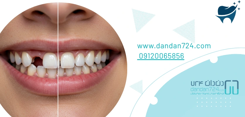 تاثیر پروتز - پروتز دندان