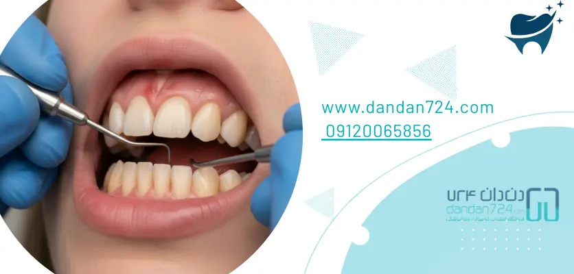 تشخیص بیماری - پیوره لثه