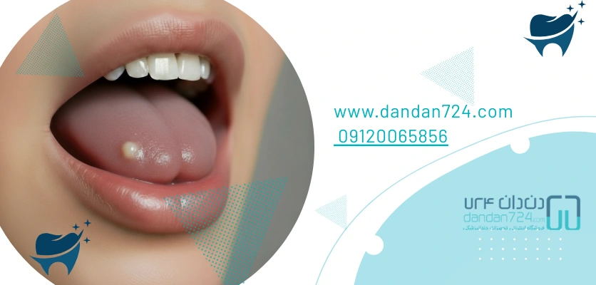 استوماتیت سرخک - آفت دهان