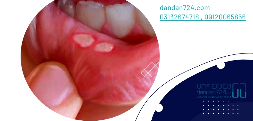 بیماری های دهانی - آفت دهان