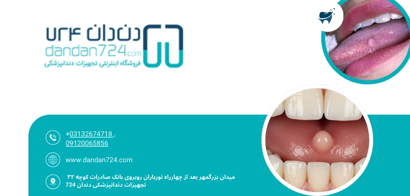 برجستگی دهانی - فیبروم دهان
