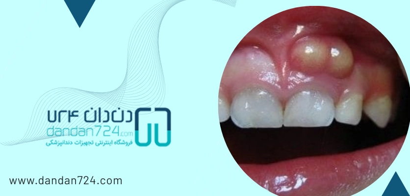 بیماری های دهانی - عفونت دندان
