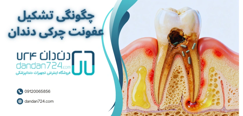 نحوه تشکیل عفونت دندان - آبسه دندان