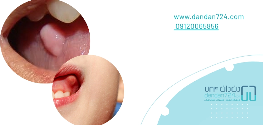 ضایعه دهانی - فیبروم دهان