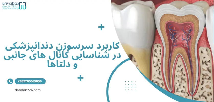 کانال ها - کاربرد سرسوزن دندانپزشکی