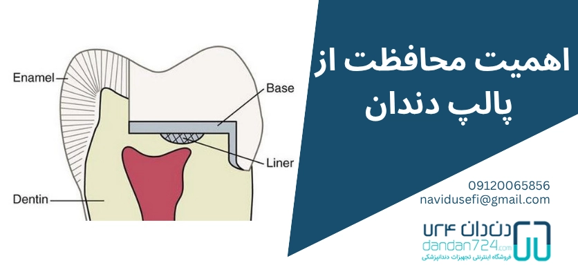 حفاظت از پالپ دندان - کف بندی دندان