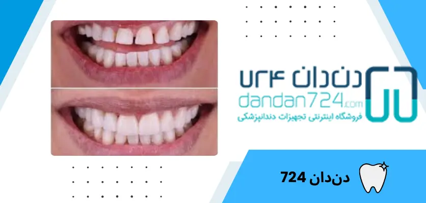 باندینگ2 - باندینگ دندان