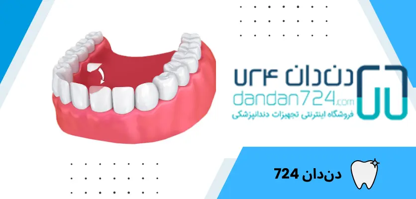 باندینگ3 - باندینگ دندان