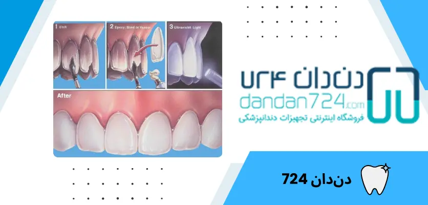 باندینگ4 - باندینگ دندان