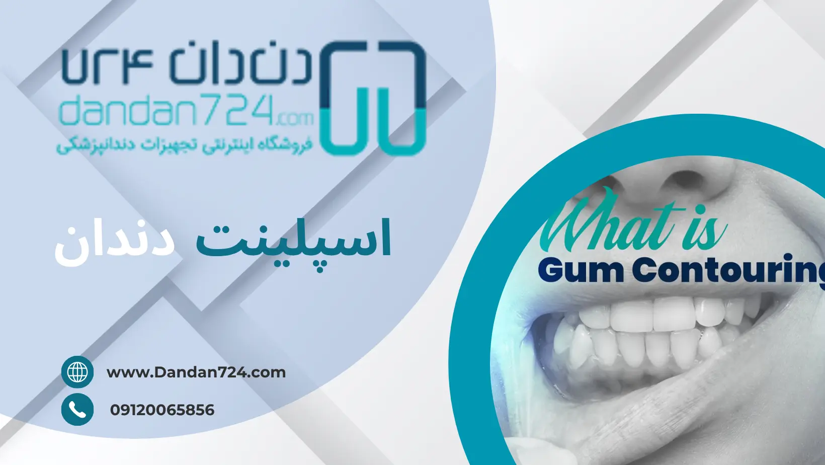 شاخص - اسپلینت دندان