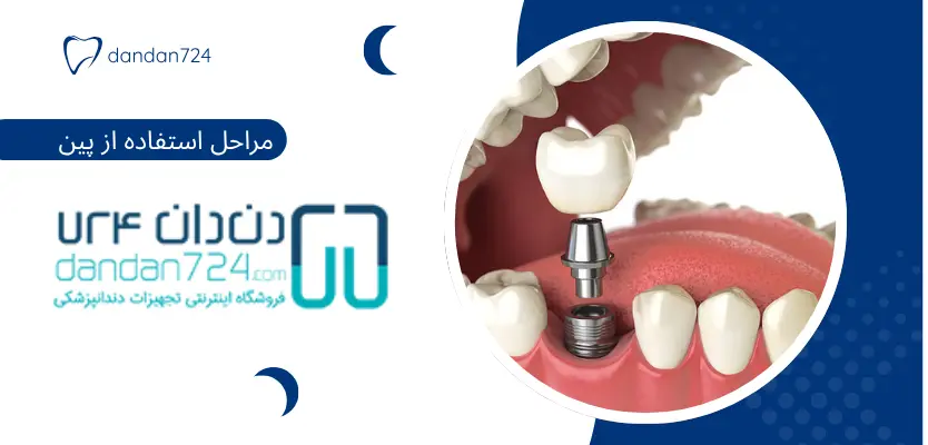 مراحل پین - پین در دندانپزشکی