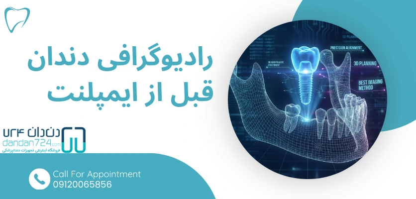 رادیوگرافی دندان قبل از ایمپلنت - رادیوگرافی ایمپلنت دندان